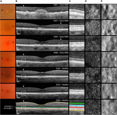 The Relationship Between Perifoveal L-Cone Isolating Visual Acuity and Cone Photoreceptor Spacing—Understanding the Transition Between Healthy Aging and Early AMD